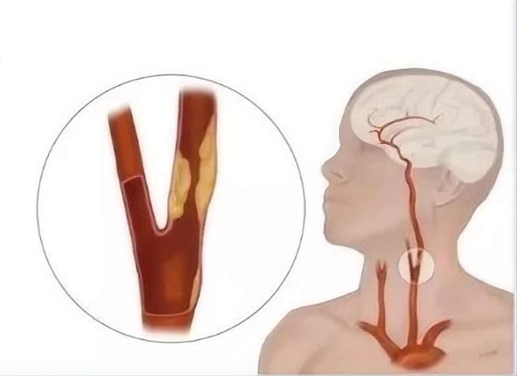 超千万中国人体检结果：两成有颈动脉斑块